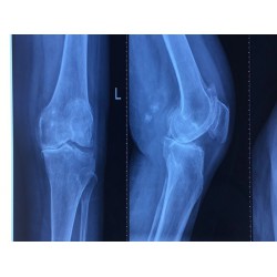 治疗膝关节关节炎哪家好-靠谱的治疗膝关节置换推荐